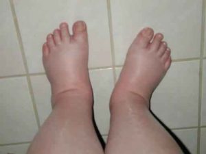 Swollen Foot And Legs