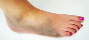 Foot Care for Diabetics