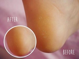 Listerine Foot Soak Before and After