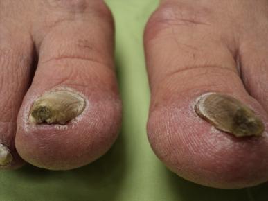 Athlete's foot - Wikipedia