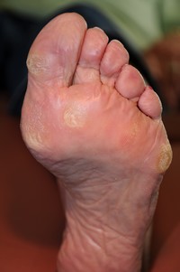 Calluses On Feet Remedies