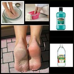 Vinegar and Listerine Foot Soak
