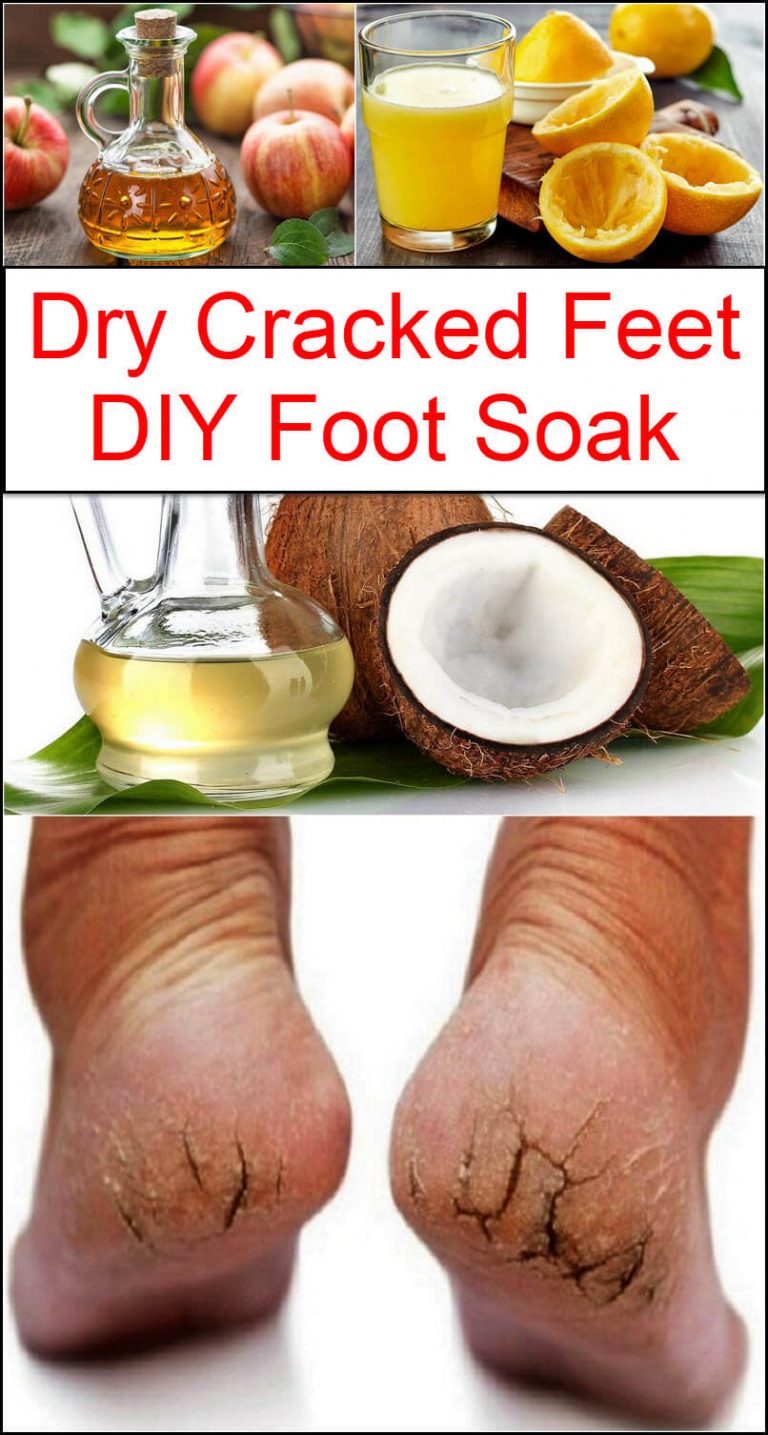 Dry Cracked Feet DIY Foot Soak Listerine Foot Soak