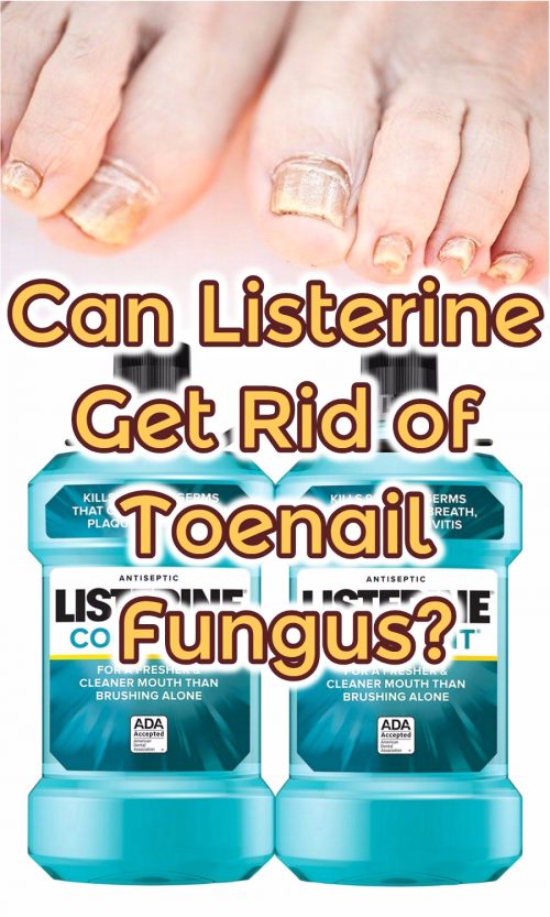 Can Listerine Get Rid of Toenail Fungus? Listerine Foot Soak