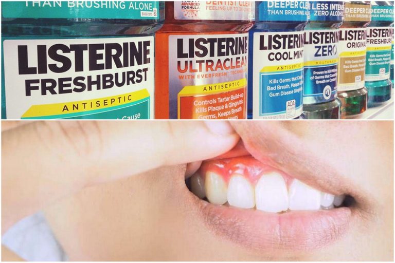 Listerine for Gum Disease Gingivitis Listerine Foot Soak