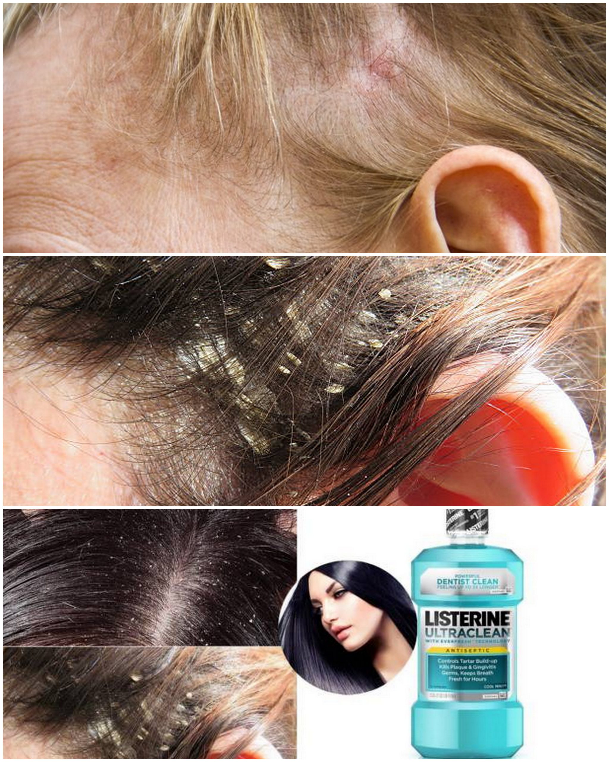 Listerine for Scalp Fungus