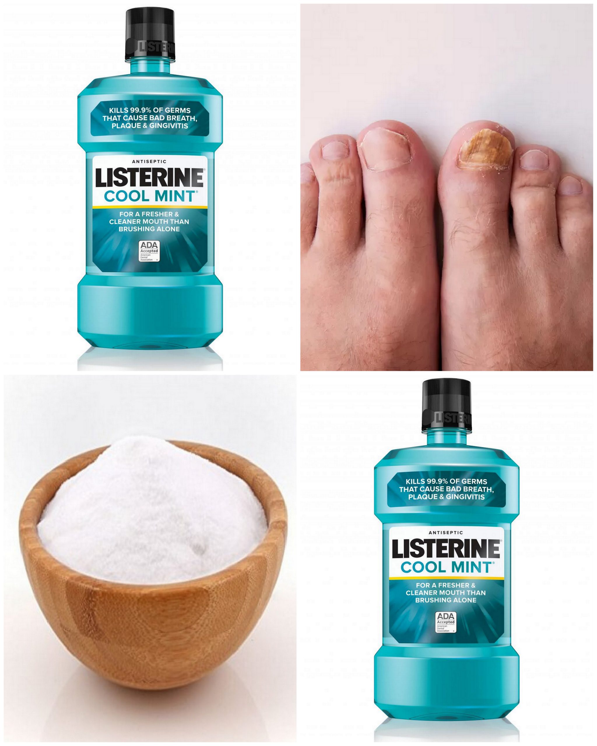 listerine toenail fungus